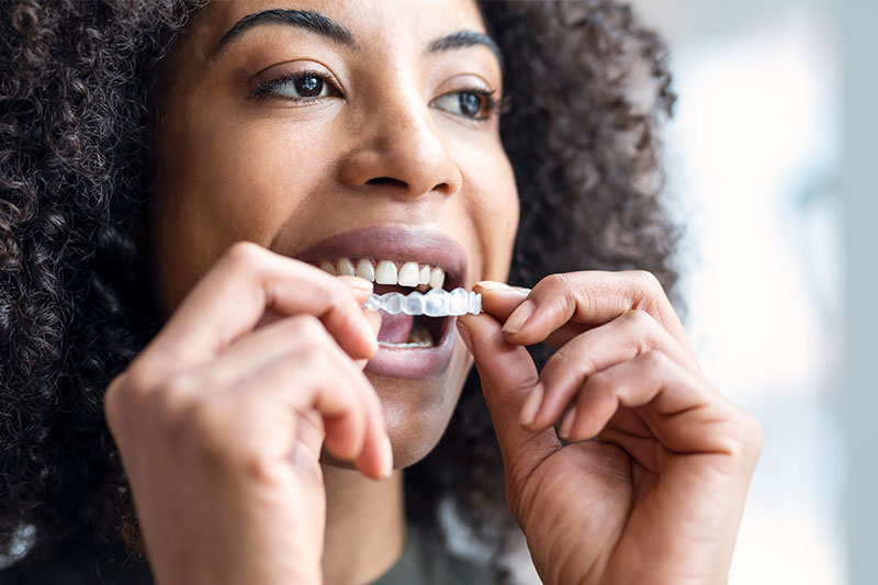 Clear Aligners in Clarksville
