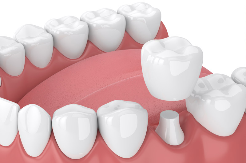 Dental Crowns in Clarksville