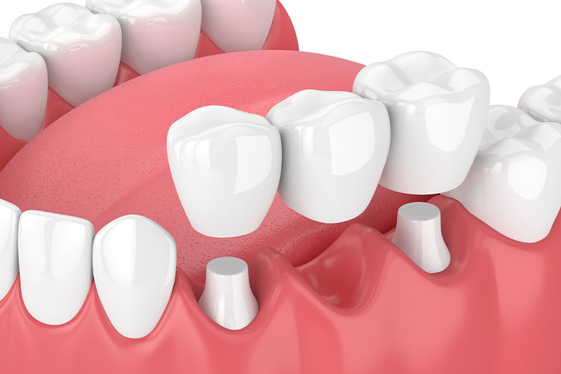 Dental Bridges in Clarksville