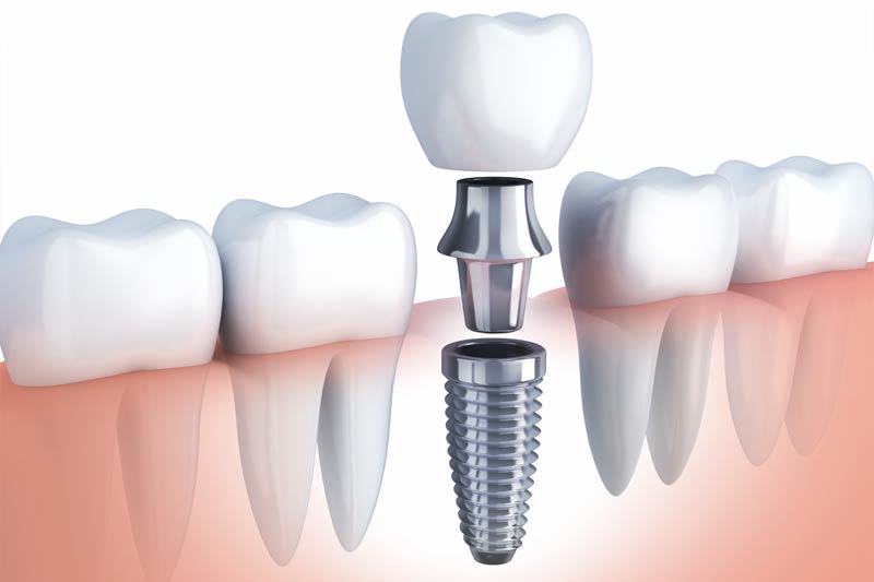 Dental Implants in Clarksville