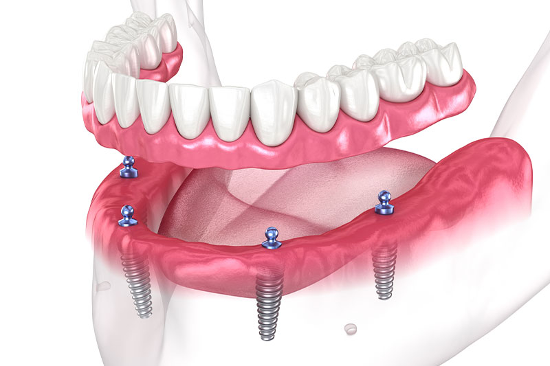 Overdentures in Clarksville